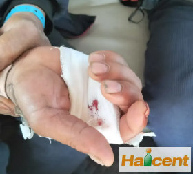 燕京啤酒炸伤消费者手指，事发两个月仍未解决